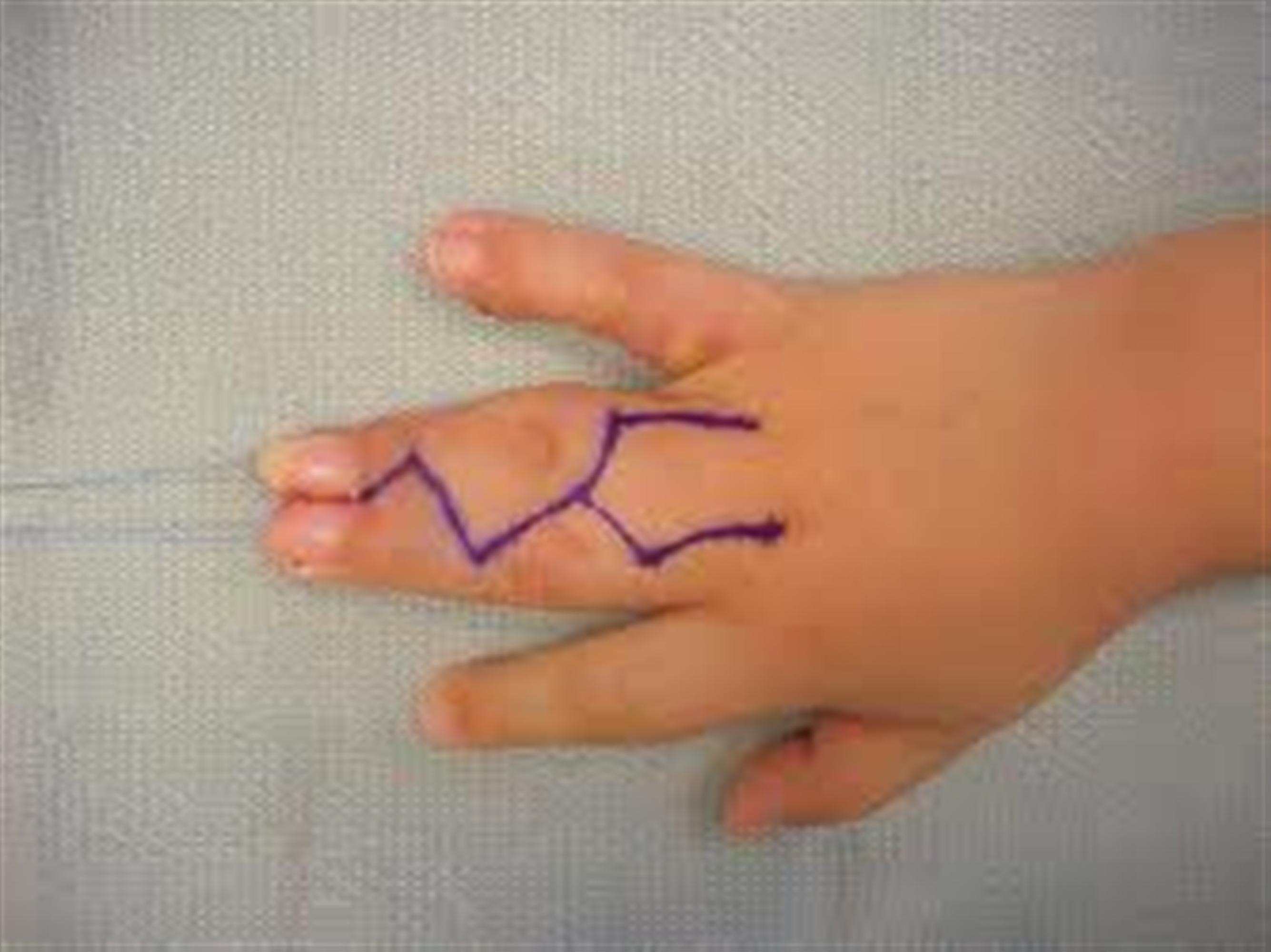 Syndactyly Hand Orthobullets